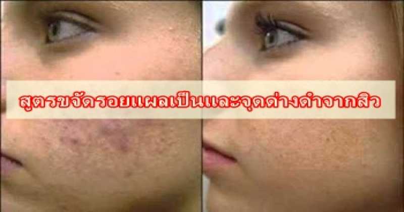 อยากหน้าใสต้องอ่าน 7 สูตรขจัดรอยแผลเป็นและจุดด่างดำจากสิวที่คุณทำได้ด้วยตัวเอง