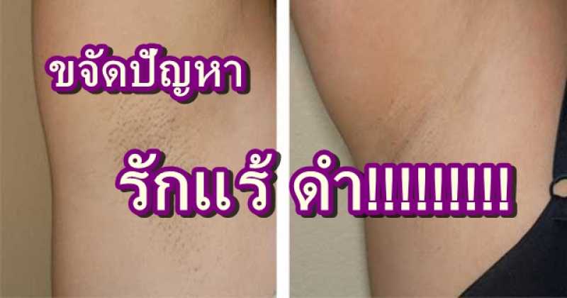 รักแร้ดำ!!! ปัญญาโลกแตก จัดการง่ายๆด้วยของใช้ในบ้าน